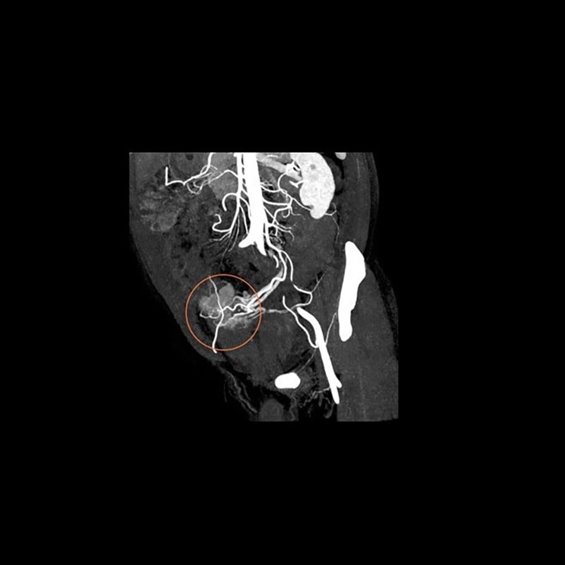 Спектральная КТ-система 256 срезов Revolution Discovery CT